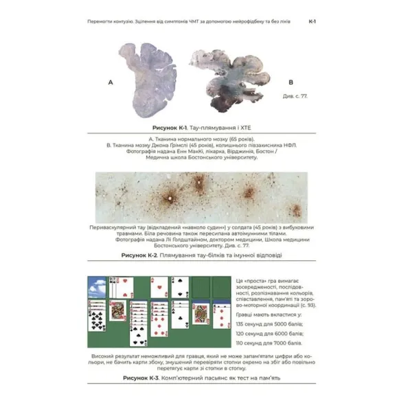 Conquering Concussion: Healing TBI Symptoms With Neurofeedback and Without Drugs